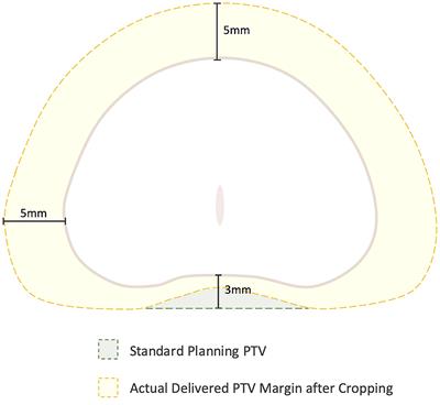 Rationale for Utilization of Hydrogel Rectal Spacers in Dose Escalated SBRT for the Treatment of Unfavorable Risk Prostate Cancer